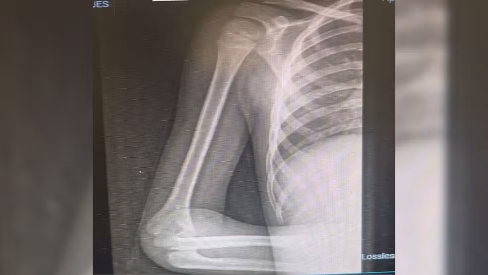 Dor no braço e mistério médico: menino de 6 anos é diagnosticado com tipo raro de câncer no interior de SP