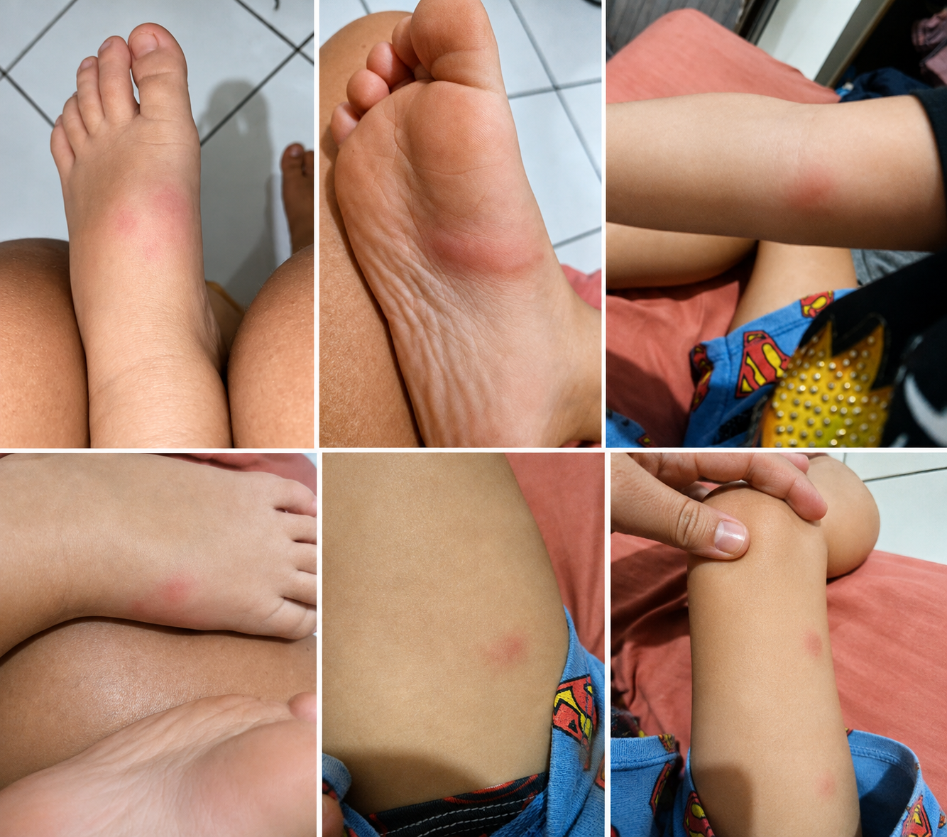 Surto de picadas em creche de Birigui gera reclamação e revolta de mães